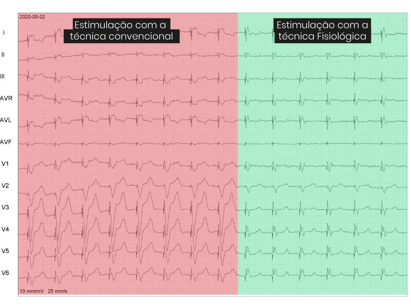 Estimulacao-usando-a-tecnica-fisiologica.png